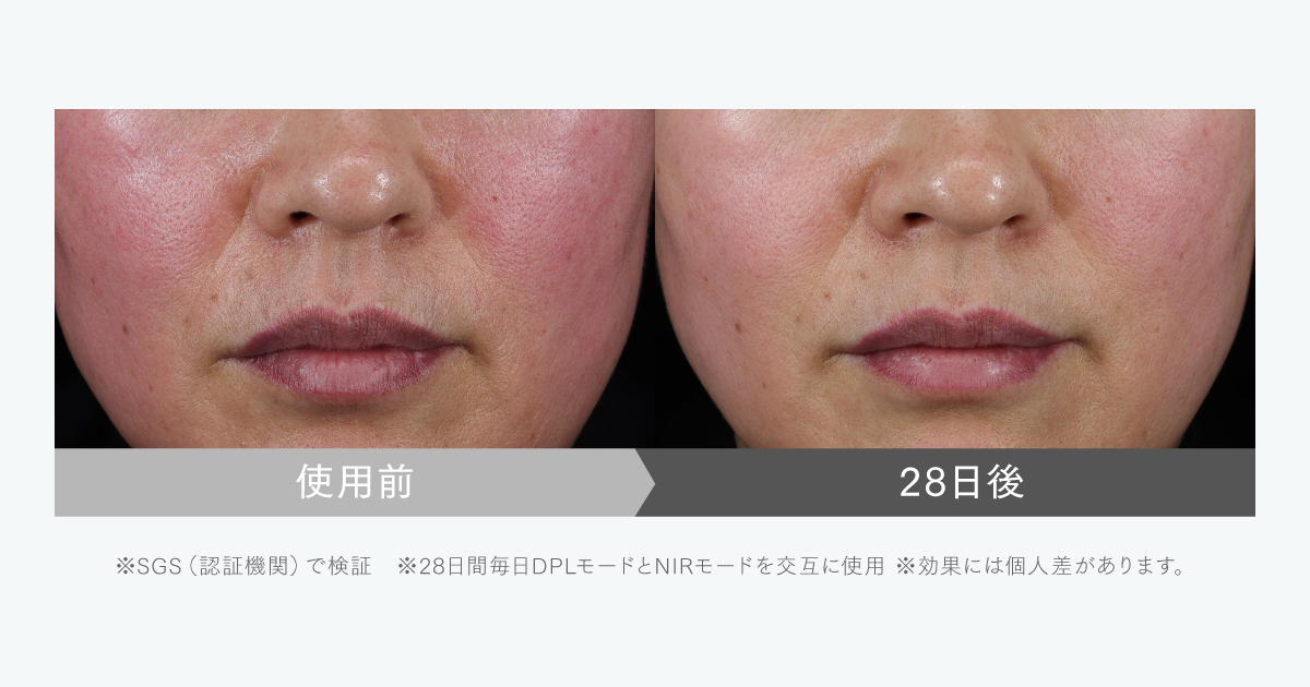 “フォト×EMSのWリフト*¹”で話題の光美顔器。
3年の開発期間を経て完成した、次世代エイジングケア*²の決定版