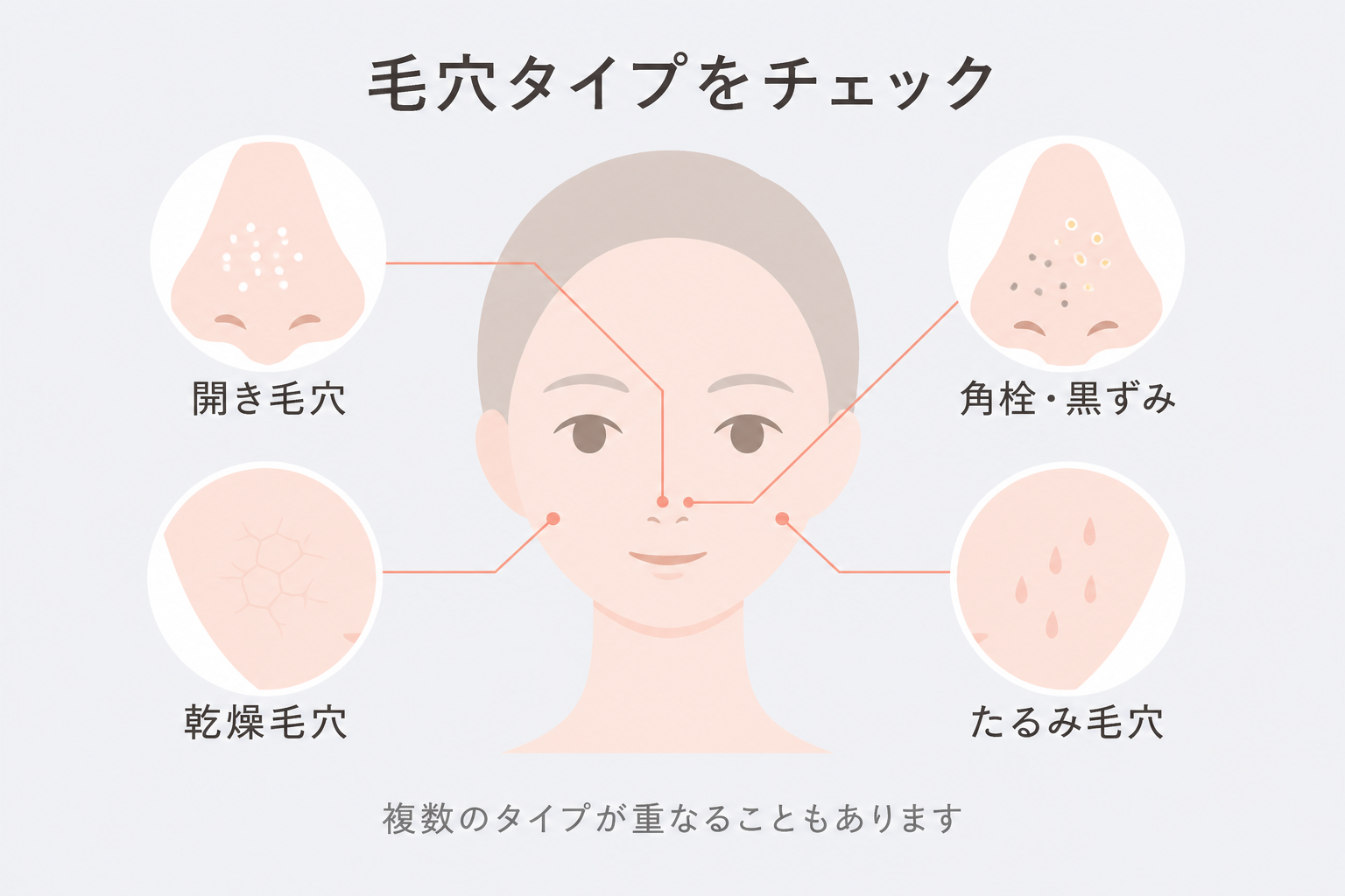 開き毛穴・角栓・黒ずみ・乾燥毛穴・たるみ毛穴のタイプ判定イラスト