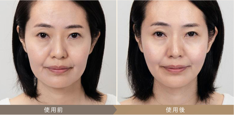 MYTREXマイトレックス ミライワン美顔器 フォト機能の効果