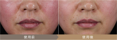 SGS検証機関におけるMYTREXマイトレックス ミライワン美顔器 フォト機能の効果