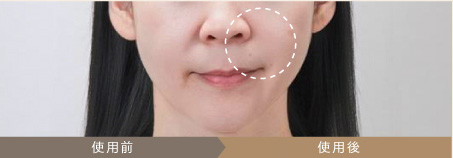 MYTREXマイトレックス ミライワン美顔器 EMSの効果