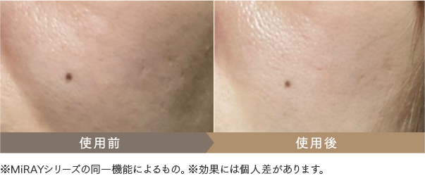 MYTREXマイトレックス美顔器DPLフォト機能による肌への効果