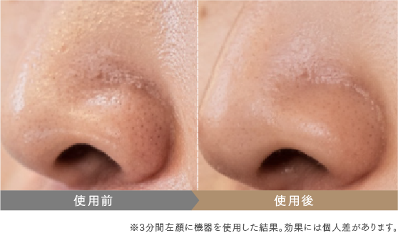 MYTREX マイトレックス 美顔器のイオン導出機能を鼻の毛穴の黒ずみや引き締めに使用した効果