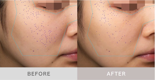 PROVE　CORE(ブラシ型アタッチメント使用による)毛穴の変化