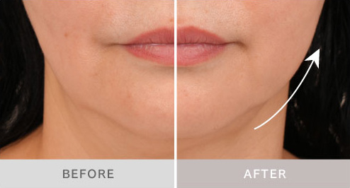 フェイス用アタッチメントを1回使用したときの印象の変化